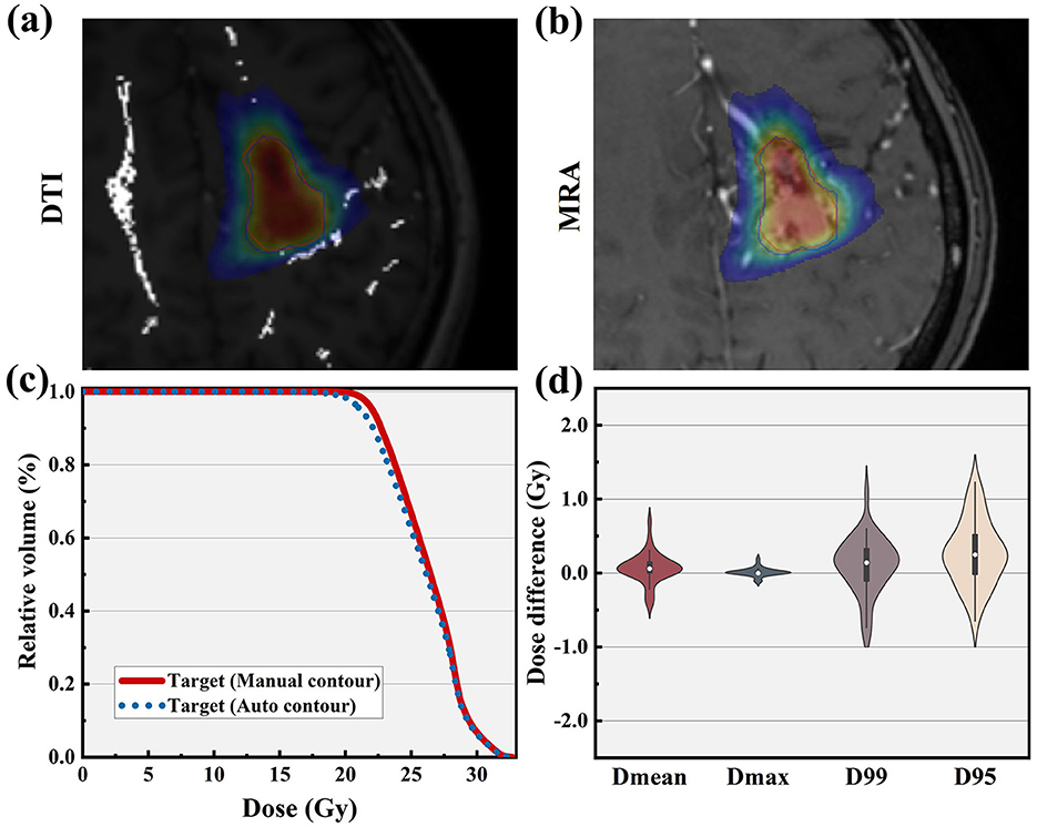 Four-part image with the following panels: (a) DTI scan with colored target contour. (b) MRA scan showing similar contours as in DTI. (c) Graph plotting relative volume against dose in gray (Gy) with two lines for manual and auto contours. (d) Violin plot depicting dose difference for Dmean, Dmax, D99, and D95.
