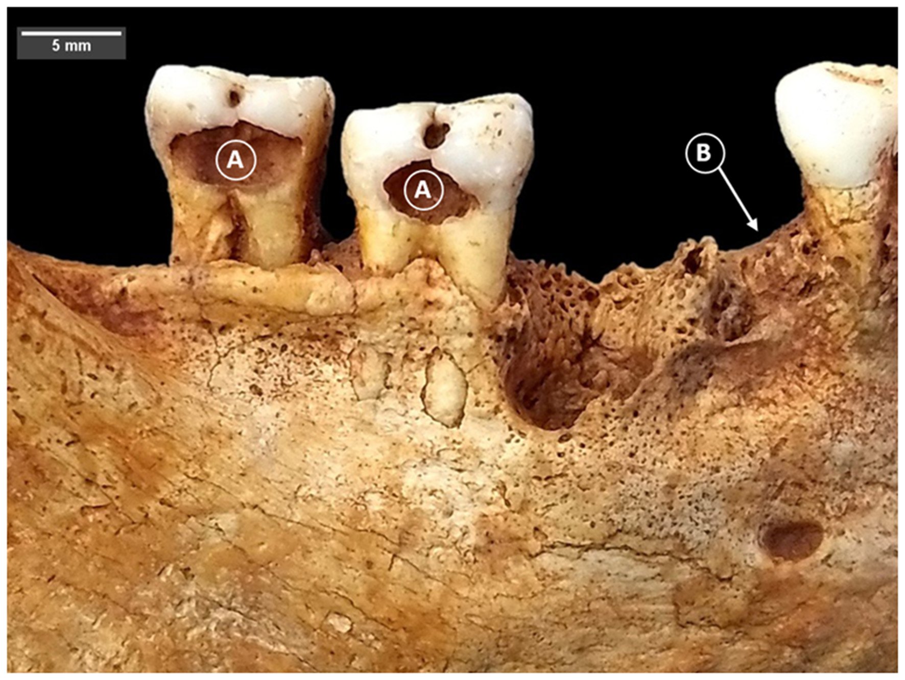 Close-up of two teeth embedded in a section of jawbone, labeled “A,” with visible cavities. An arrow labeled “B” points to an area of bone resorption. A scale indicates 5 millimeters.