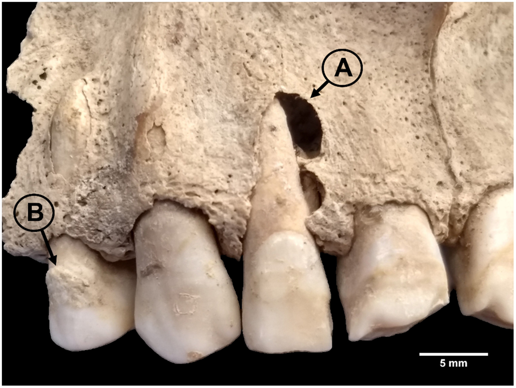 Close-up of a jawbone fragment with four visible teeth. A labeled hole, marked “A,” appears above one tooth, while another label, “B,” points to an area on the bone. A scale bar indicating 5 millimeters is visible at the bottom.