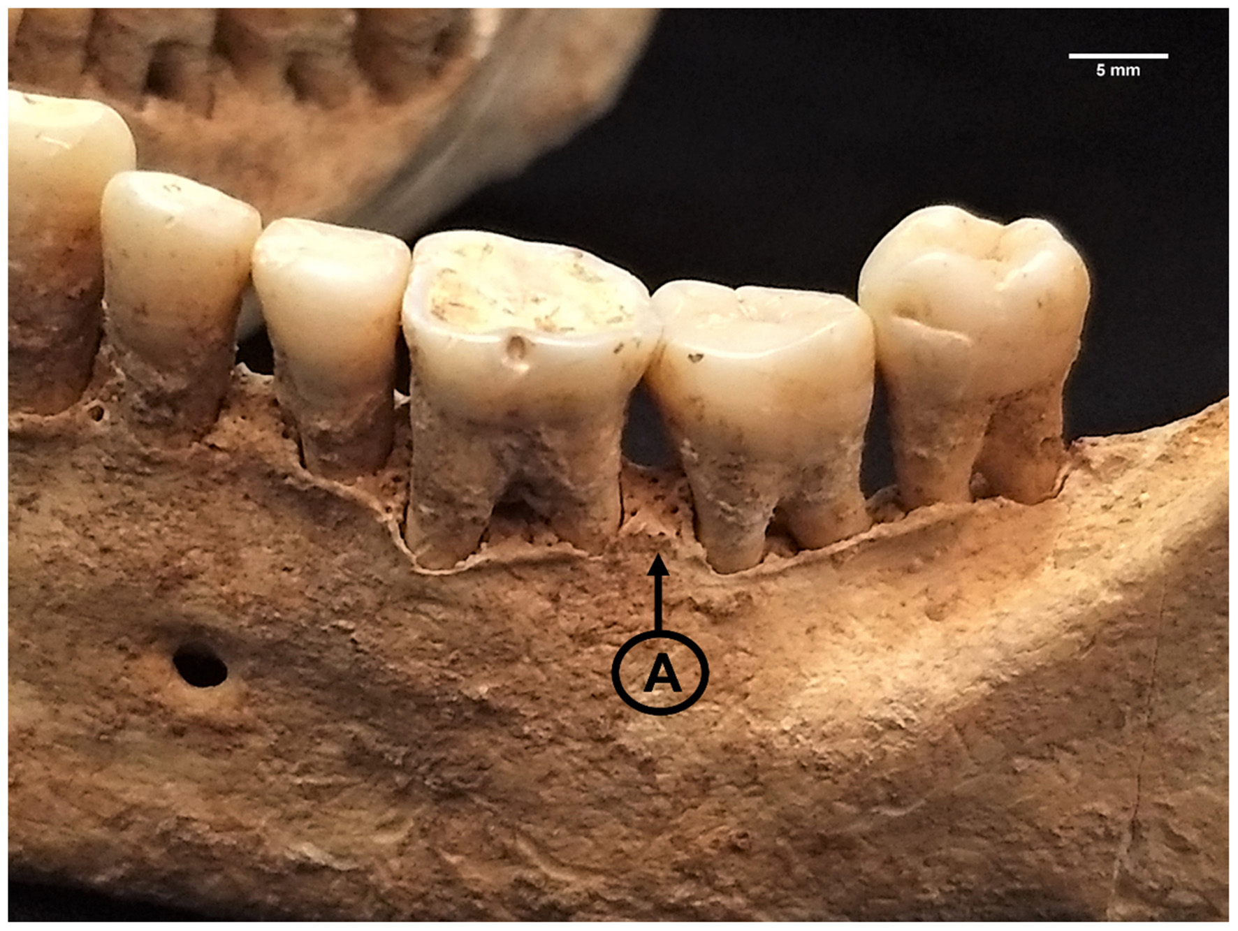 A close-up view of a section of human lower jawbone with several teeth intact. An arrow labeled “A” points to a particular area near the gum line beneath the second tooth from the left. A scale indicating five millimeters is in the top right corner.