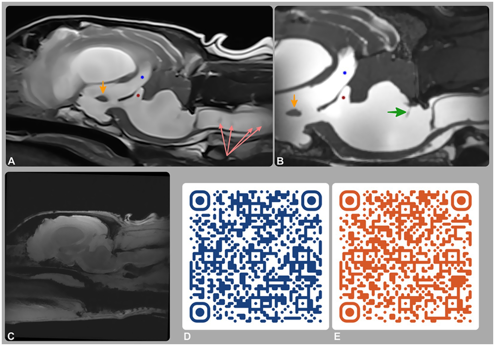 Magnetic resonance imaging of the brain and cervical spine. (A) shows a T2-weighted mid-sagittal image, (B) a 3D-CISS mid-sagittal image, and (C–E) phase-contrast MRI including a re-phase image (C) and QR-code-linked videos of magnitude (D) and phase (E) sequences. Findings include tetraventricular hydrocephalus, supracollicular fluid accumulation, and dilation of the third (blue star) and fourth (red star) ventricles. A green arrow highlights a membrane within the fourth ventricle, representing a stretched rostral medullary velum. CSF flow is preserved intraventricularly but absent at the lateral apertures.