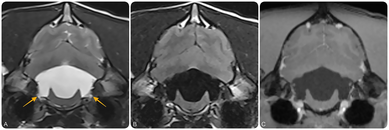 Magnetic resonance imaging of the brain at the level of the fourth ventricle and lateral recesses. (A) shows a transverse T2-weighted image, (B) a T2-FLAIR image, (C) a T1-weighted post-contrast image. Bilateral dilation of the lateral recesses is marked with yellow arrows, suggesting impaired cerebrospinal fluid outflow at the lateral apertures. No contrast-enhancing or intraventricular cystic lesions are visible.