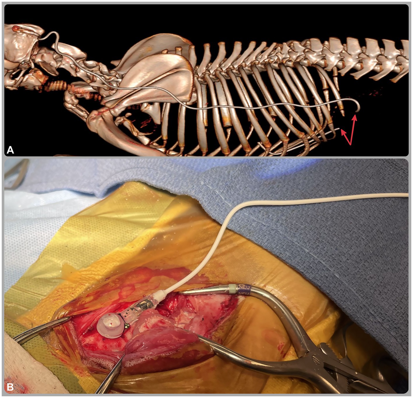 (A) shows a three-dimensional reconstructed computed tomography image from the caudal head to the cranial lumbar spine. Red arrows mark fracture of the distal ventriculoperitoneal shunt catheter at the abdominal wall, likely related to patient growth. (B) shows an intraoperative image with a Codman Hakim right-angle medium-pressure valve implanted in the skull and connected to the distal catheter. Surgical instruments surround the site.
