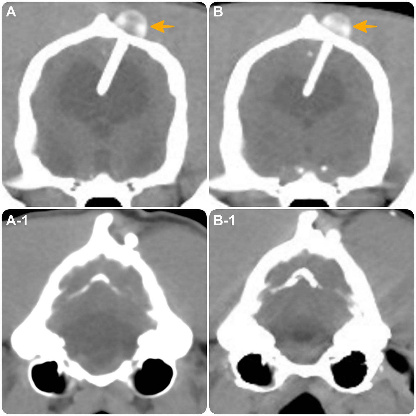 Transverse computed tomography images of the brain. (A) and (B), obtained at the level of the interthalamic adhesion, and (A1) and (B1), obtained at the level of the fourth ventricle. Images (A) and (A1) were taken at the time of distal catheter fracture, showing hydrocephalus. Images (B) and (B1), taken 10 months after revision surgery, demonstrate intact shunt positioning (yellow arrow) with reduction in hydrocephalus and expansion of brain parenchyma compared with the images at the time of the fracture.