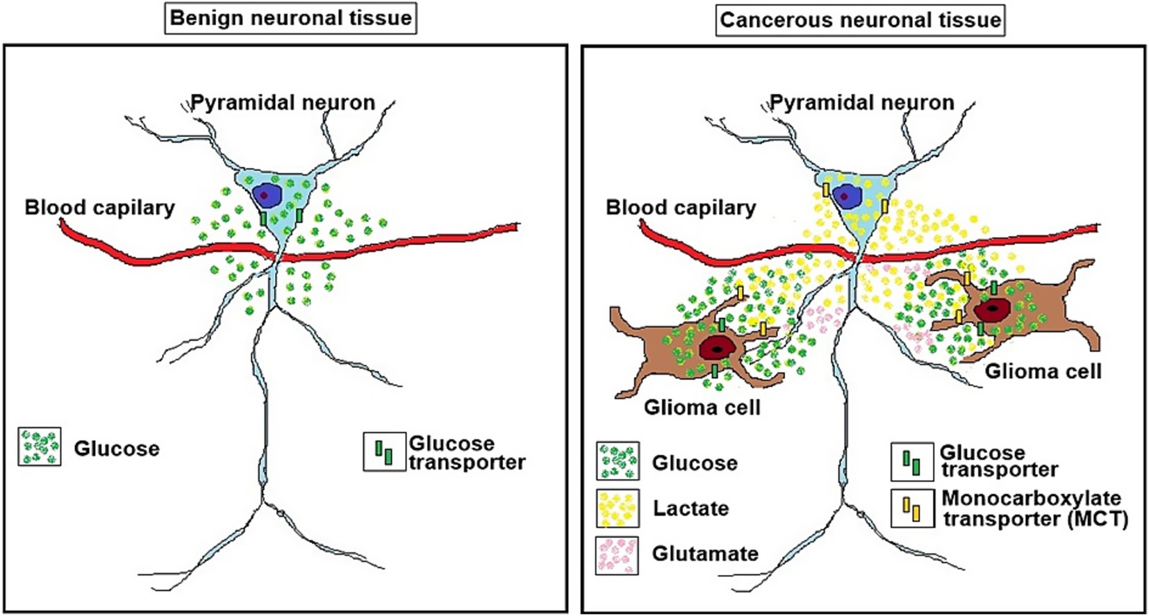 Diagram comparing benign and cancerous neuronal tissue. The left panel shows a benign pyramidal neuron with glucose and glucose transporters near a blood capillary. The right panel depicts a cancerous context with a glioma cell, showing glucose, lactate, glutamate, glucose transporters, and monocarboxylate transporters around a blood capillary.