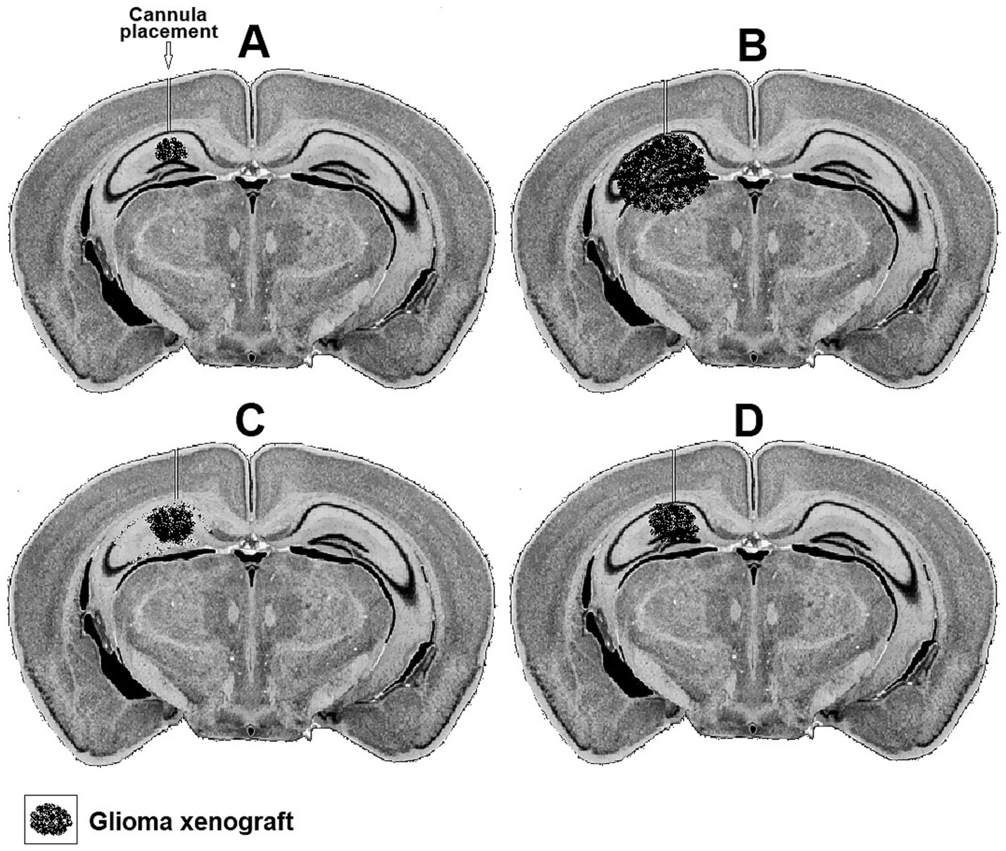 Coronal brain sections A, B, C, and D show glioma xenografts. Section A indicates cannula placement. Glioma growth is visible in all sections, with varying sizes and locations.