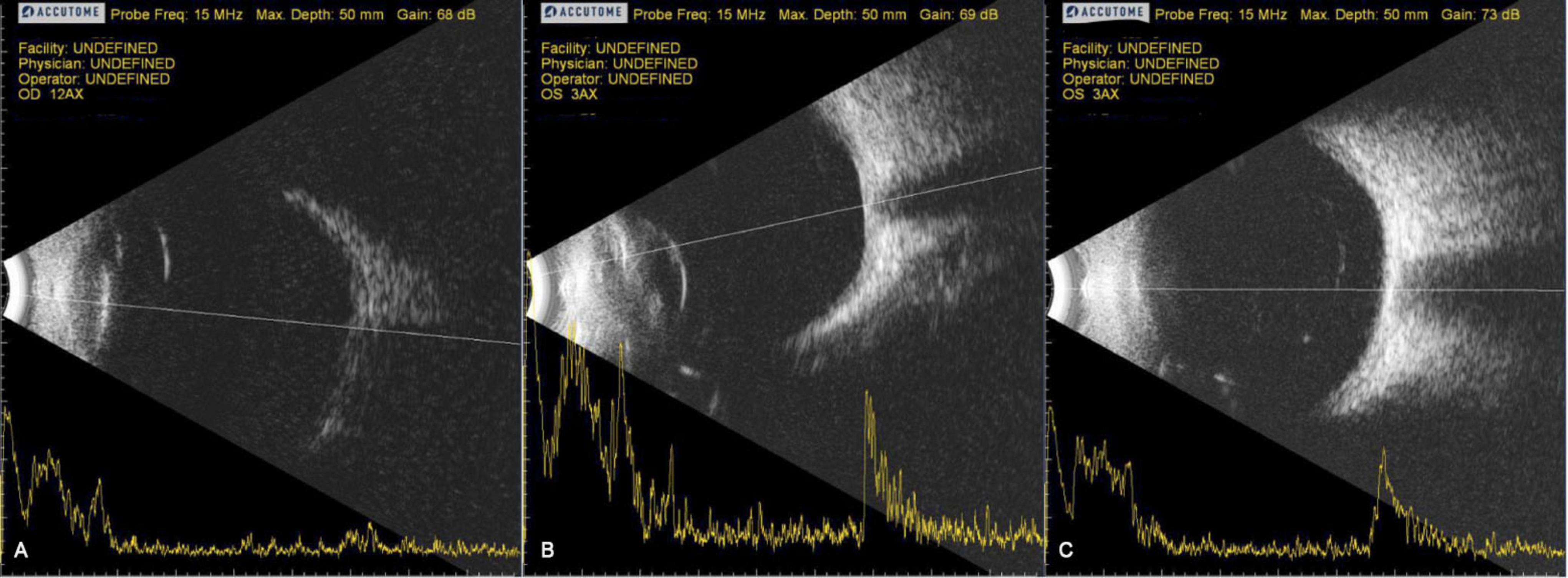 Three ultrasound images with ophthalmic measurements display eye structures from different angles. Each image shows labeled readings: OD 12AX, OS 3AX, and OS 3AX. The probe frequency is 15 MHz with a maximum depth of 50 mm for all images, and gain settings vary slightly.
