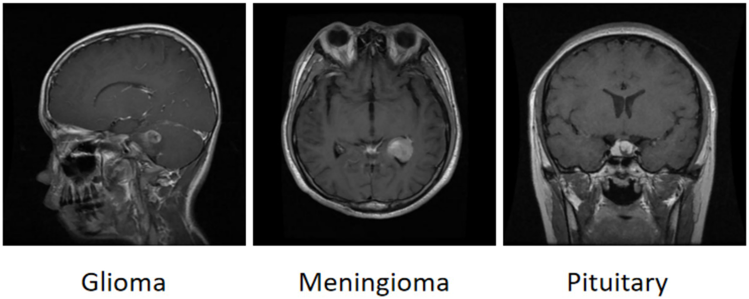 MRI images showing three different types of brain tumors. The left image is a sagittal view of a glioma, the center image is an axial view of a meningioma, and the right image is a coronal view of a pituitary tumor.