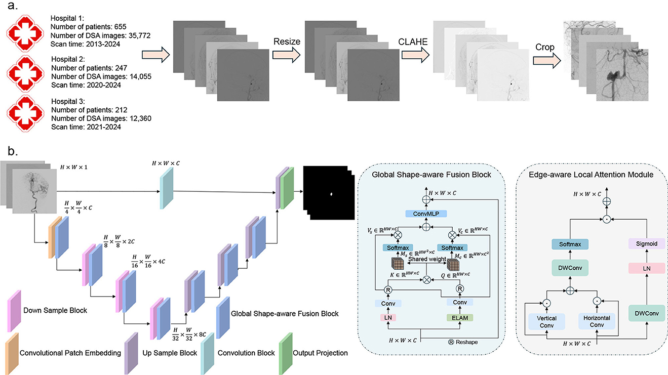 Flowchart illustrating two processes (the overall pipeline). Panel a) describes the data collection process, detailing patient numbers, DSA images, and scan times from 2013 to 2024. Images are preprocessed with a series of operations including resizing, CLAHE processing, and cropping. Panel b) displays a diagram of a neural network architecture with detailed components: layers for down-sampling, convolutional patch embedding, up-sampling, and output prediction. It includes details of a global shape-aware fusion block and an edge-aware local attention module.