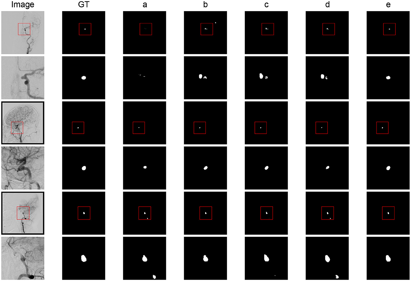 Angiographic images in the left column and corresponding segmentation results in the adjacent columns labeled GT, a, b, c, d, and e. Each row shows a source brain image with a red box highlighting a specific area, followed by segmented results in black with white outlines inside red boxes. The segmented images differ in detail and shape across the columns.