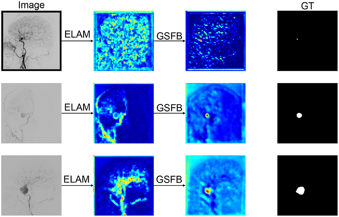 Comparison of medical image segmentation results using different models. Three sets of angiogram images are shown, each expanded for detailed view. Models SwinUNetR, SegNet, and SDAN produce segmented outputs with corresponding Dice Similarity Coefficient (DSC) scores. First set DSCs: 0.9000, 0.6576, 0.9146. Second set DSCs: 0.5976, 0.8082, 0.9080. Third set DSCs: 0.8120, 0.8437, 0.8902.