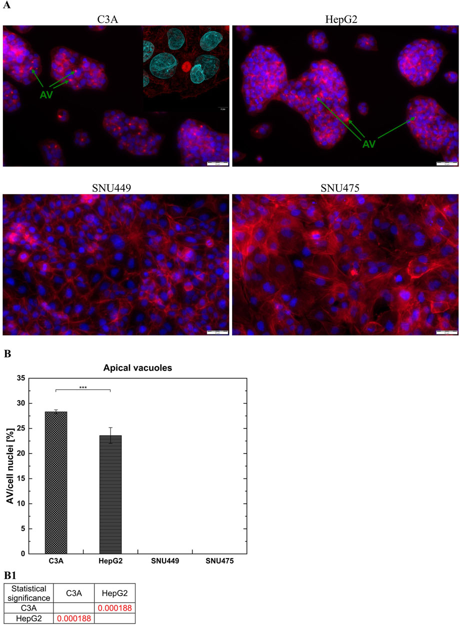 Panel A displays fluorescent microscopy images of cell lines C3A, HepG2, SNU449, and SNU475 highlighting apical vacuoles with blue and red staining. Arrows indicate vacuoles in C3A and HepG2. Panel B shows a bar graph quantifying apical vacuoles as percentages of cell nuclei in these cell lines, with statistical significance indicated. Panel B1 provides a table with statistical significance values, highlighting significant differences in red for C3A and HepG2.