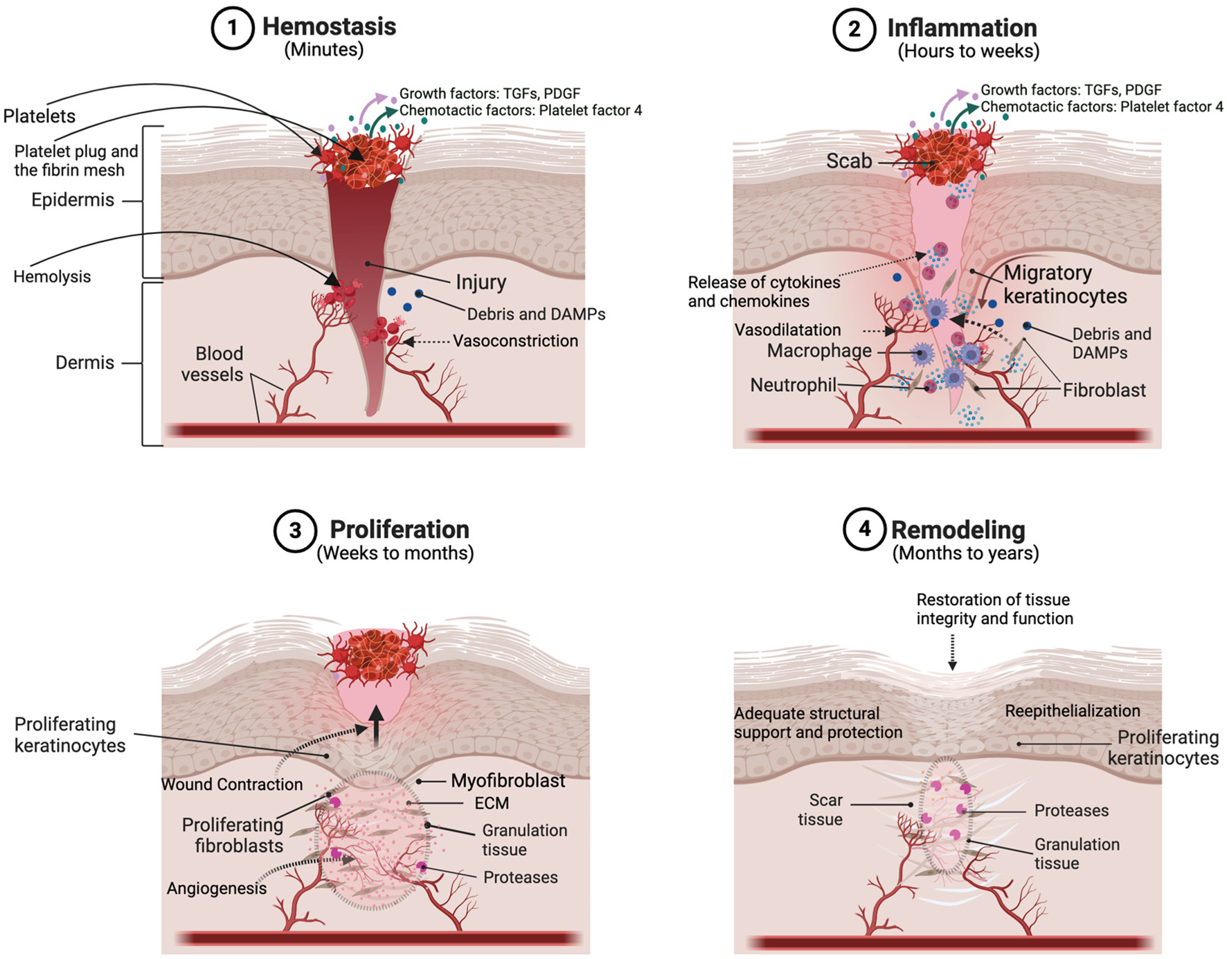Four-panel diagram showing the stages of wound healing. 1. Hemostasis (minutes): Blood clotting with platelet plug formation and fibrin mesh in injury area.2. Inflammation (hours to weeks): Scab forms, immune response with cytokines and chemokines release; neutrophils and macrophages present.3. Proliferation (weeks to months): Keratinocytes and fibroblasts proliferate, forming granulation tissue and angiogenesis occurs.4. Remodeling (months to years): Scar tissue forms, reepithelialization leads to restoration of tissue integrity and function.