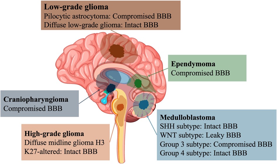 Illustration of a brain highlighting locations of different tumor types with their blood-brain barrier (BBB) status. Low-grade gliomas and craniopharyngiomas have compromised BBB. Ependymomas also show compromised BBB. High-grade gliomas and some medulloblastomas have either intact or leaky BBB, depending on the subtype.