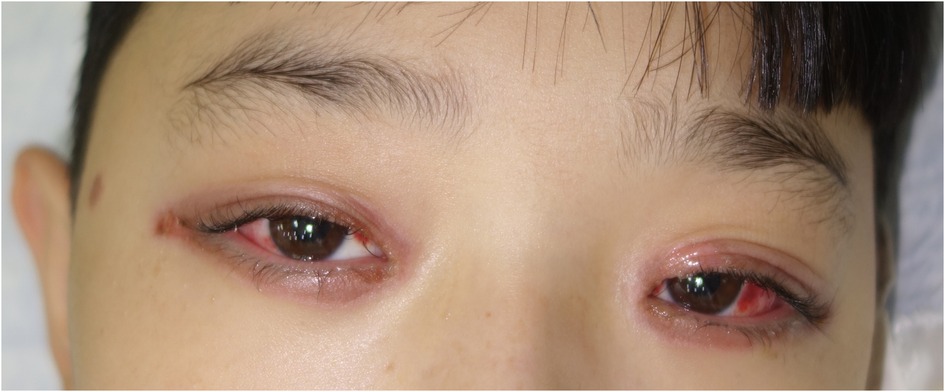 Close-up of a person's eyes showing severe conjunctival inflammation. The eyes appear red and swollen. The skin around the eyes is unblemished, with some irritation at the corners.