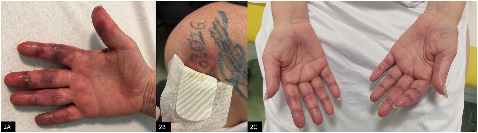 Three-panel image showing medical conditions. Panel 2A: A hand with lesions and discoloration on fingers. Panel 2B: A tattooed shoulder with a bandaged lesion. Panel 2C: Another hand with inflammation and signs of healing on fingers and palm.
