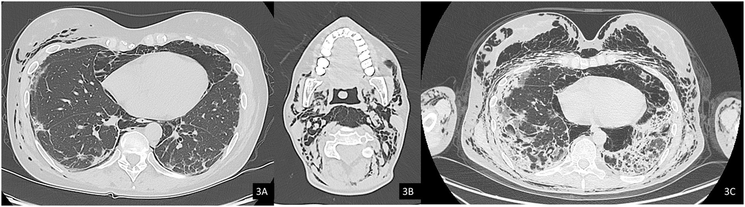 CT scans of the chest show three cross-sectional slices labeled 3A, 3B, and 3C. The images reveal varying degrees of lung abnormalities, including areas of increased density and patterns suggesting possible interstitial or alveolar changes.