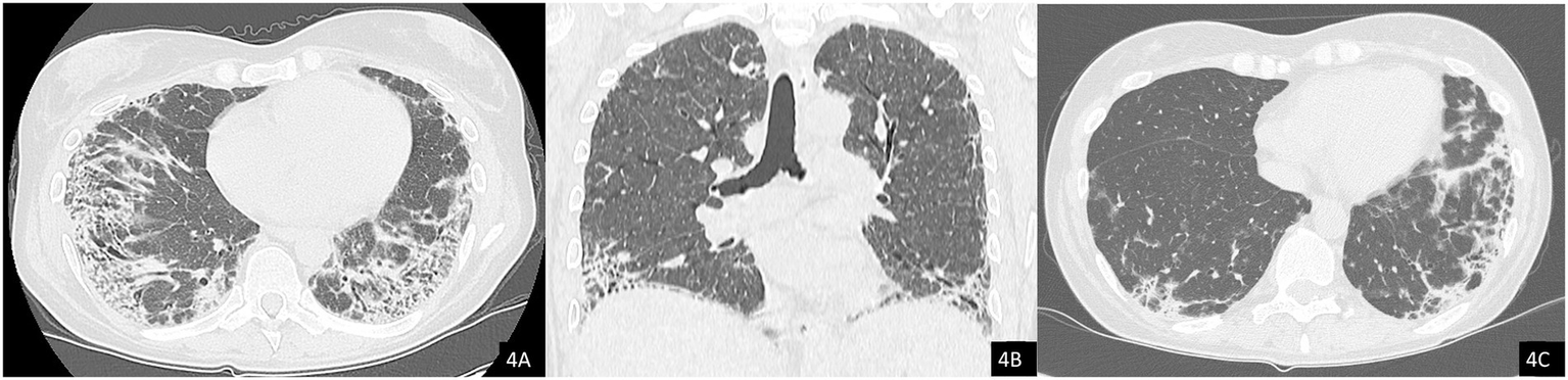Three CT scan images of lungs showing varying extents of pattern changes. Image 4A depicts noticeable fibrosis in both lungs. Image 4B shows fibrosis primarily in the right lung. Image 4C displays fibrosis extensively in both lungs, more pronounced than 4A.