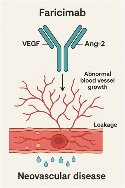 Diagram illustrating Faricimab, a treatment targeting VEGF and Ang-2. It shows abnormal blood vessel growth leading to leakage, associated with neovascular disease.
