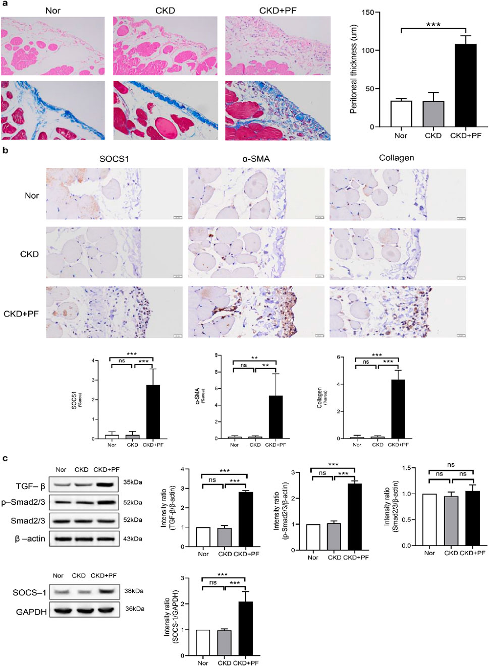 Histological and molecular analysis images compare normal (Nor), chronic kidney disease (CKD), and CKD with PF treatment. Panel (a) shows stained tissue sections and a bar graph of peritoneal thickness, indicating increased thickness in CKD+PF. Panel (b) presents immunohistochemistry for SOCS1, α-SMA, and collagen with corresponding bar graphs showing increased expression in CKD+PF. Panel (c) features Western blot results and intensity ratios for TGF-β, Smad2/3, and SOCS-1, indicating higher levels in CKD+PF, with statistical significance marked by asterisks.