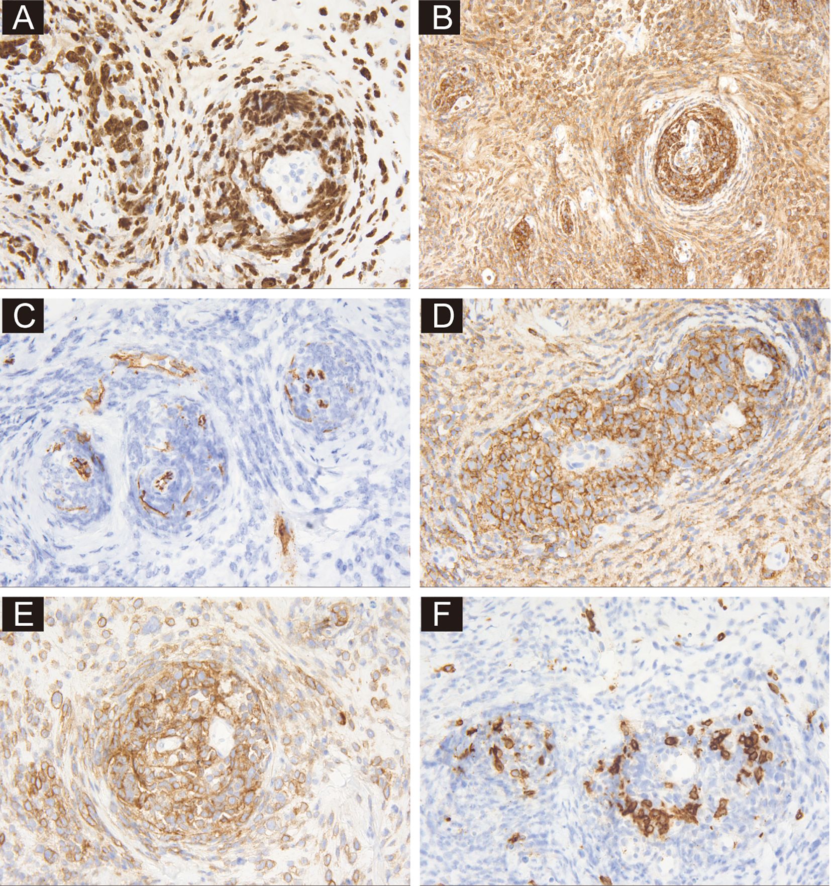 Histological images labeled A to F, showing tissue samples stained with different markers. Sample A displays dark brown stained cells concentrated in clusters. Sample B shows a dense network of brown fibers. Sample C has a lighter blue background with sparse brown spots. Sample D illustrates a defined brown-outline around cellular structures. Sample E presents a larger, circular brown-stained cluster. Sample F shows scattered dark brown spots on a lighter background.
