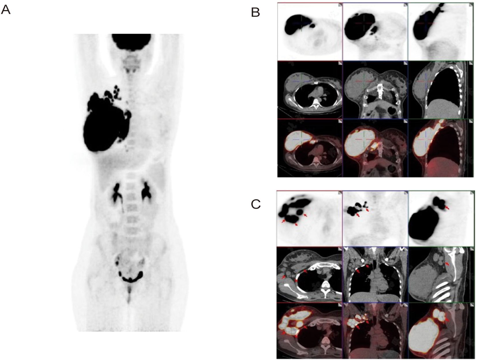 Medical imaging series showing PET and CT scans. Image A displays a whole-body PET scan highlighting metabolic activity. Image B exhibits a set of axial, coronal, and sagittal views of a CT scan showing different cross-sections with highlighted features. Image C presents similar views with additional markers indicating areas of interest, likely for diagnostic purposes.