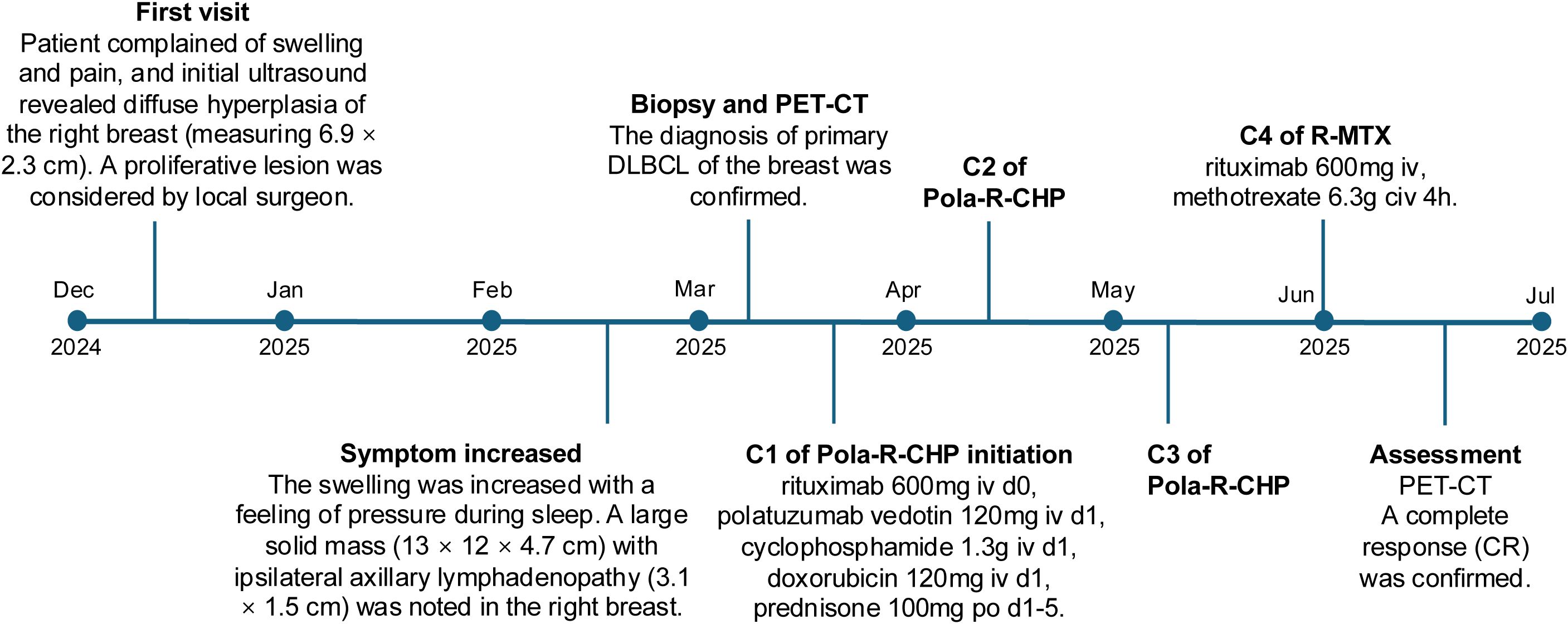 Timeline detailing a patient's medical journey from December 2024 to July 2025. Initially, swelling and pain in the right breast were noted, with diffuse hyperplasia. A January 2025 ultrasound confirmed increased symptoms and a mass. In February, a biopsy and PET-CT diagnosed primary DLBCL of the breast. March saw initiation of Pola-R-CHP treatment, followed by further treatments in April and May. In June, R-MTX was administered. By July 2025, PET-CT confirmed a complete response.