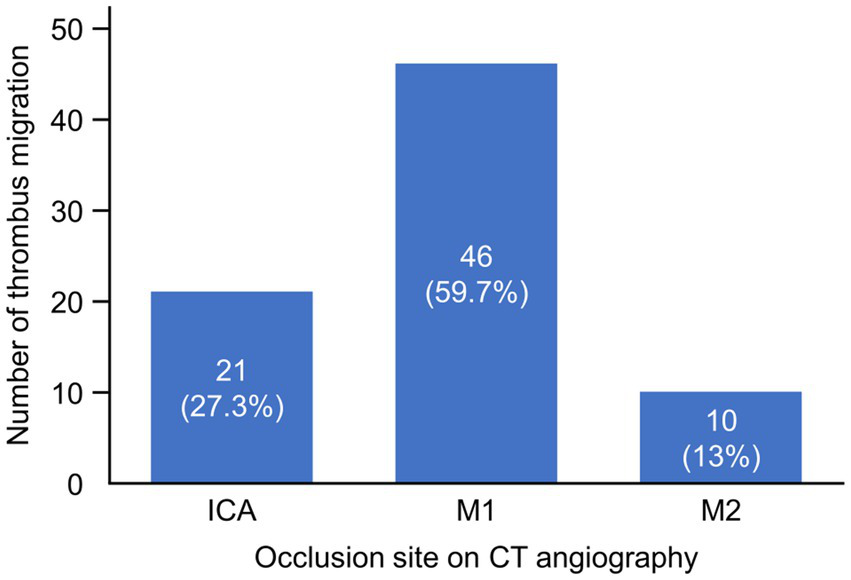 Bar chart showing the number of thrombus migrations by occlusion site on CT angiography. ICA has 21 migrations (27.3%), M1 has 46 migrations (59.7%), and M2 has 10 migrations (13%).