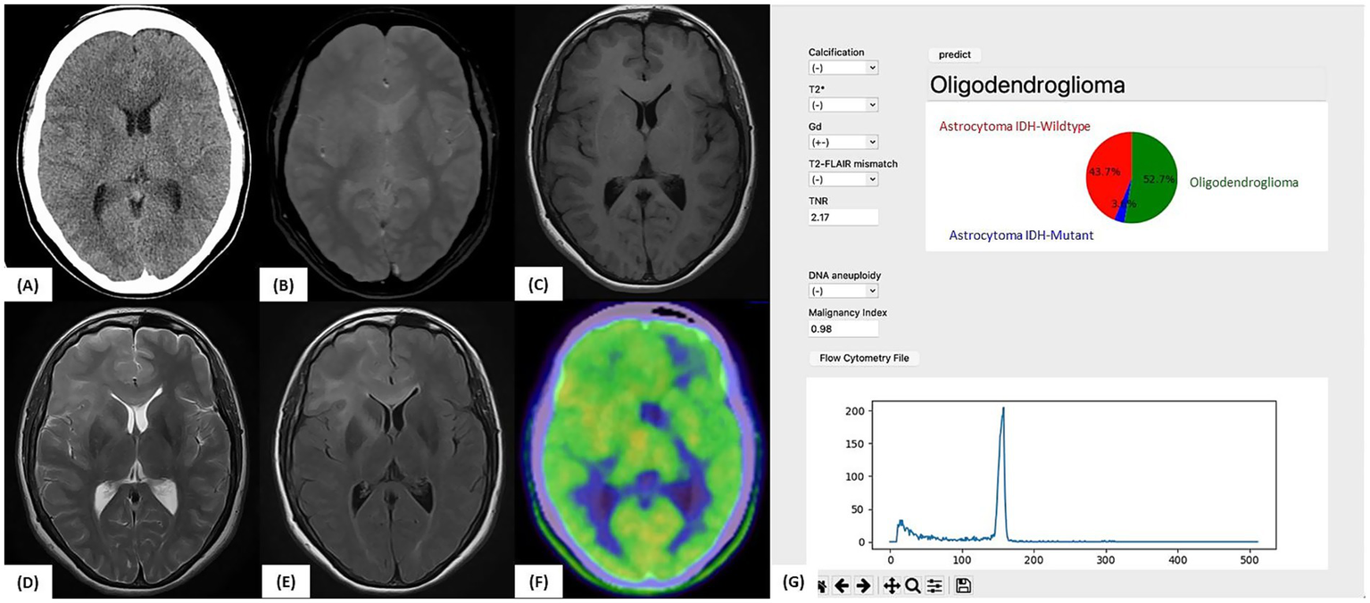 A series of brain scan images labeled (A) through (F), showing various medical imaging techniques. (G) displays a flow cytometry data chart. A diagnostic panel predicts "Oligodendroglioma" with a pie chart, showing percentages: 52.7% Oligodendroglioma, 3.6% Astrocytoma IDH-Mutant, and 43.7% Astrocytoma IDH-Wildtype. Additional details on calcification, DNA aneuploidy, and malignancy index are also shown.