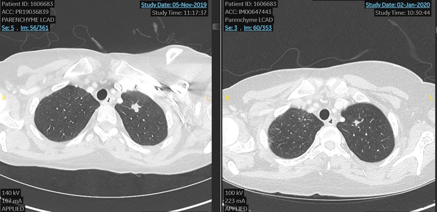 CT scan comparison of lung parenchyma images from two different dates: November 5, 2019, and January 2, 2020. Both images show axial views of the lungs with identifiable structures and contrast levels, indicating potential changes or consistency in features such as nodules or other parenchymal patterns. The images include technical details like kV and mA settings.