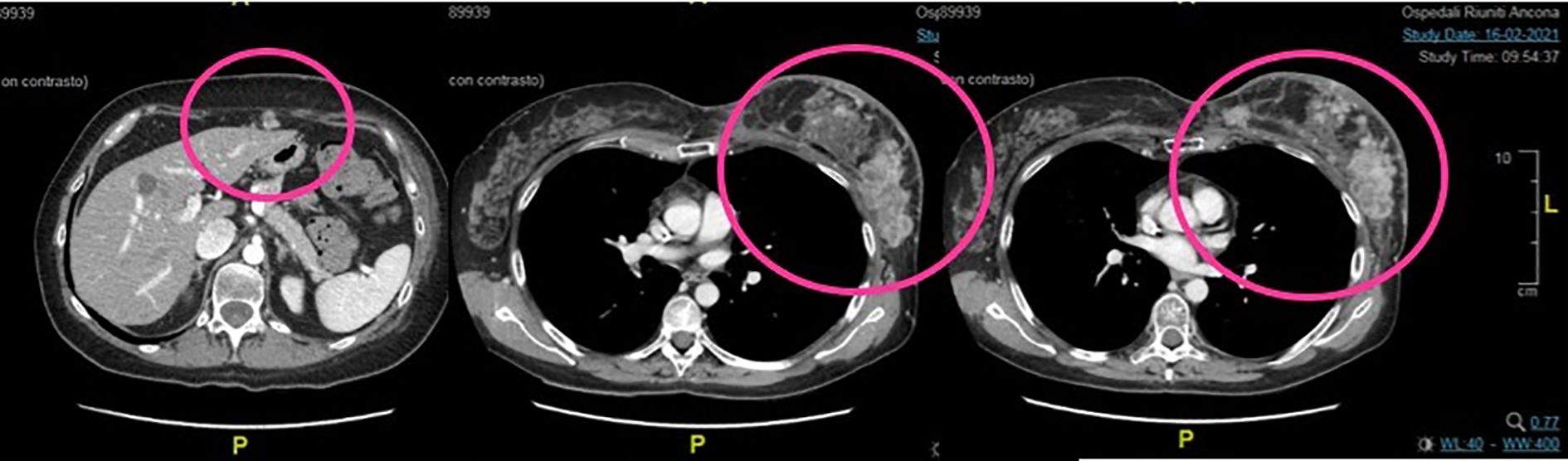 Three CT scan images with contrast, each showing different abdominal and thoracic cross-sections, are presented. Each image has a pink circle highlighting specific areas of interest, possibly indicating abnormal findings for further medical evaluation.