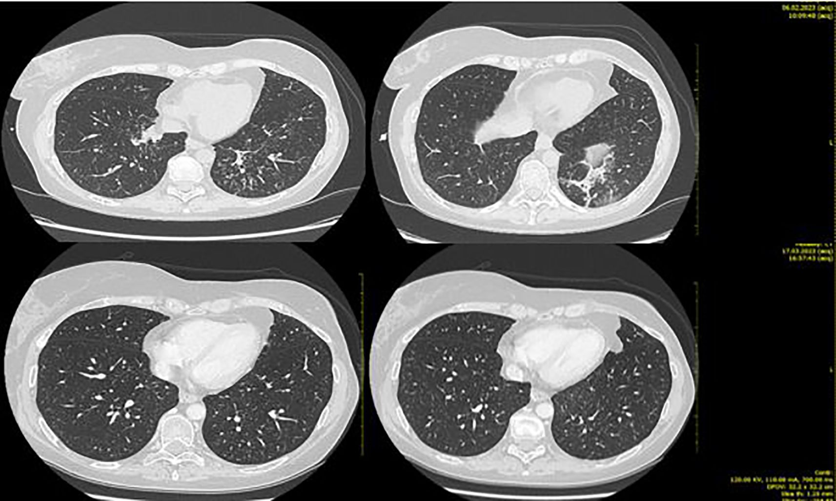 CT scan images of a human chest showing the lungs and heart in four different axial views. Each image displays lung tissue with varying levels of density, anatomical structures, and potential abnormalities.