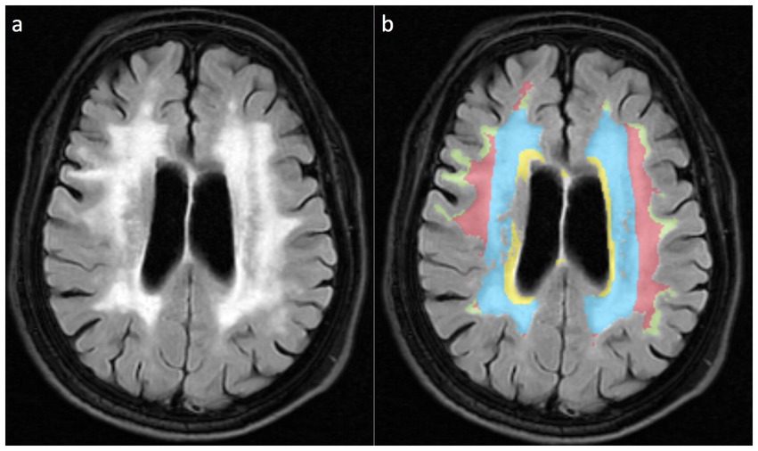 MRI brain scan comparison shows two panels. Panel a displays a standard scan with white matter lesions. Panel b highlights color-coded regions in blue, yellow, and red, possibly representing different tissue types or abnormalities.