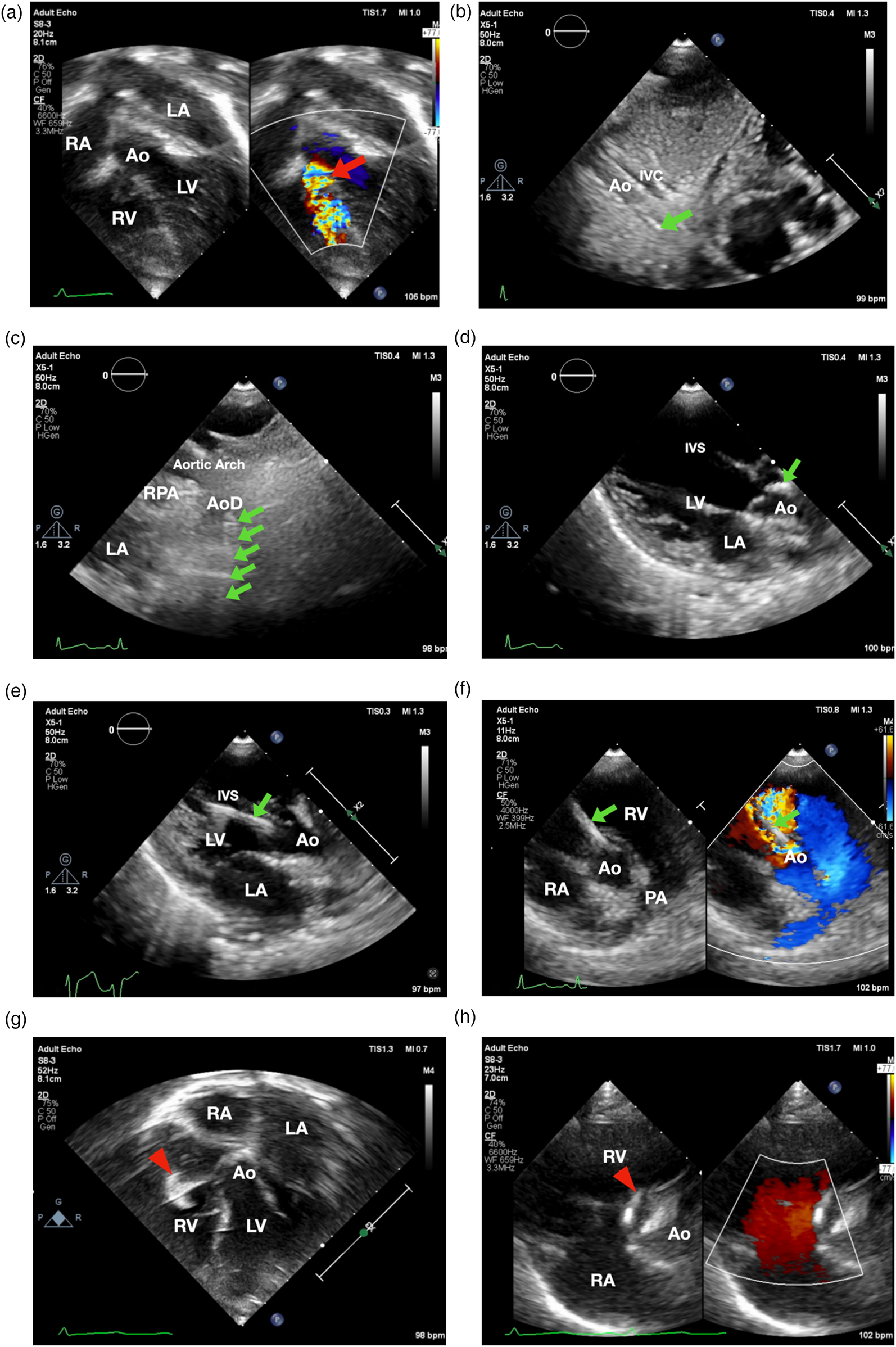 A series of echocardiography images showing different views of the heart and great vessels. Panel (a) highlights blood flow with a red arrow. Panel (b) shows the aorta and inferior vena cava, marked by a green arrow. Panel (c) displays the aortic arch and descending aorta with multiple green arrows. Panel (d) shows the interventricular septum, left ventricle, and aorta with a green arrow. Panel (e) highlights the interventricular septum with a green arrow. Panel (f) depicts the right ventricle and pulmonary artery with a green arrow and blood flow. Panels (g) and (h) highlight structures with red triangles.