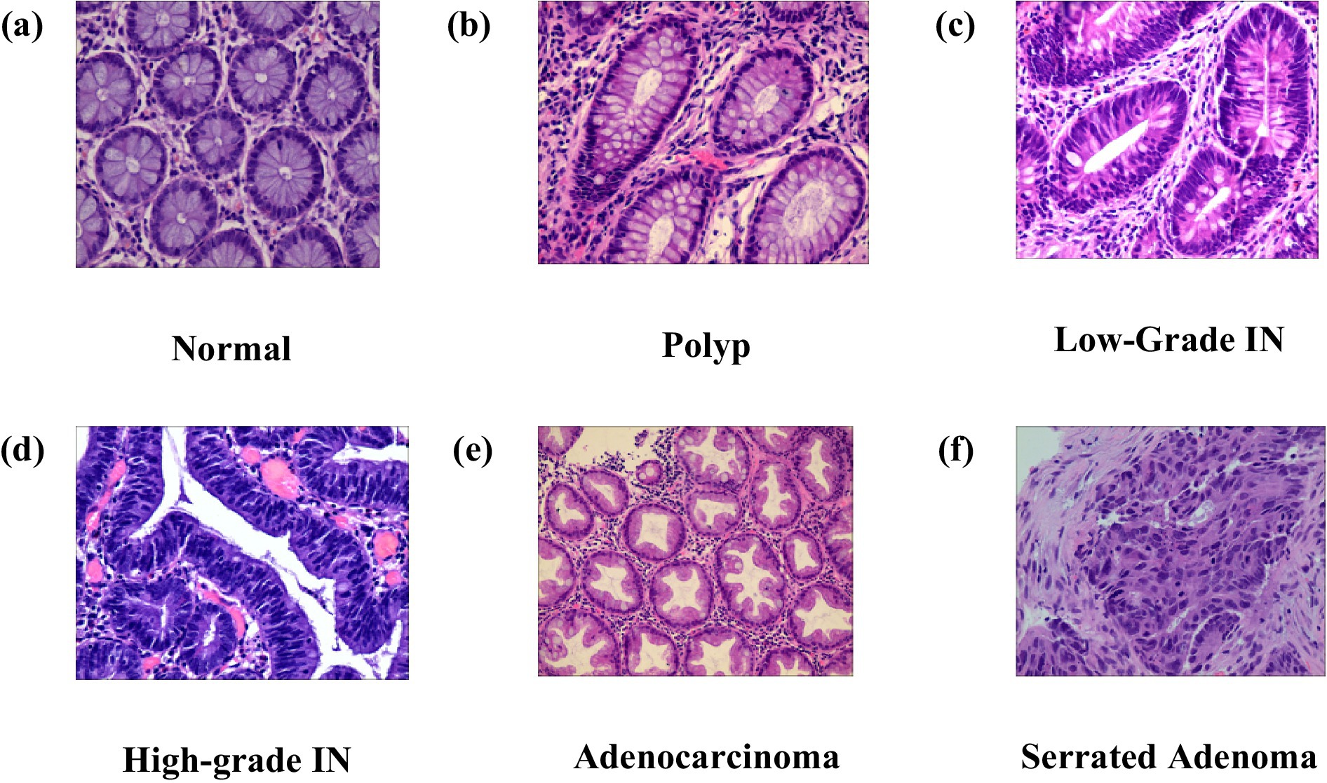 Histological slides showing six types of intestinal tissue: (a) Normal, displaying organized glands; (b) Polyp, featuring abnormal growth; (c) Low-Grade IN, with mild dysplasia; (d) High-Grade IN, indicating severe dysplasia; (e) Adenocarcinoma, with invasive cancer cells; (f) Serrated Adenoma, characterized by a saw-tooth pattern and dysplastic glands.