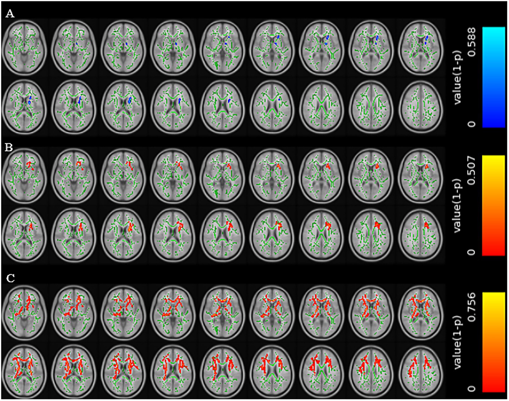 MRI scan images of a brain shown in three rows labeled A, B, and C. Each row contains multiple cross-sectional images with colored overlays. Row A includes blue, row B has red, and row C shows more intense red overlays. Each row uses a color scale on the right, indicating statistical significance, with blue to red denoting low to high values.