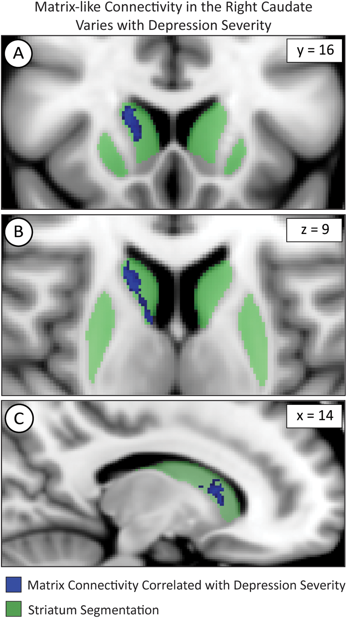 Brain scan images showing matrix-like connectivity in the rightcaudate related to depression severity. Panel A (y=16), Panel B (z=9), and Panel C (x=14). Highlighted areas in blue represent areas where matrix connectivity correlated with depression severity. Areas in green represent striatum segmentation.