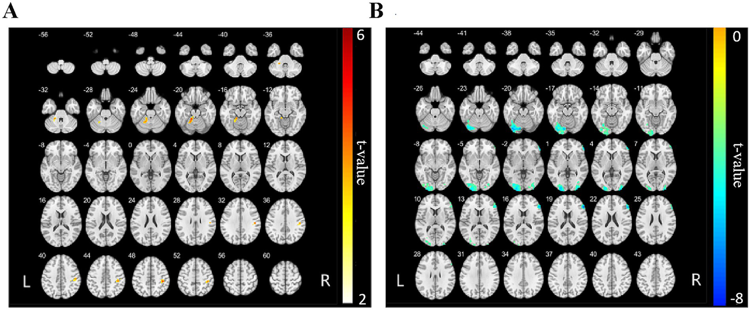 Brain MRI sections in two panels, labeled A and B. Panel A shows slices with yellow and orange highlights indicating different t-values on a color scale from two to six. Panel B displays cyan and green highlights with a t-value range from negative eight to zero. Each slice is marked with coordinates, showing left and right orientations.