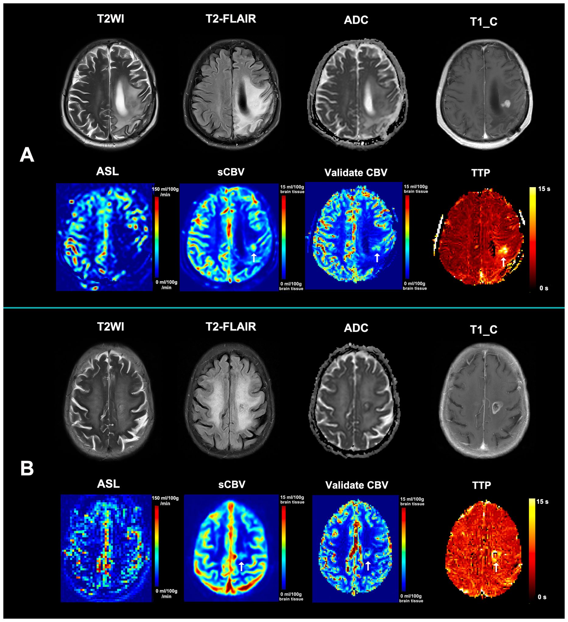 MRI scans of the brain in two sets labeled A and B. Each set includes images titled T2WI, T2-FLAIR, ADC, T1_C, ASL, sCBV, Validate CBV, and TTP. The images display varying brain activities and conditions using different scanning methods and color maps, with intensities marked by color scales.