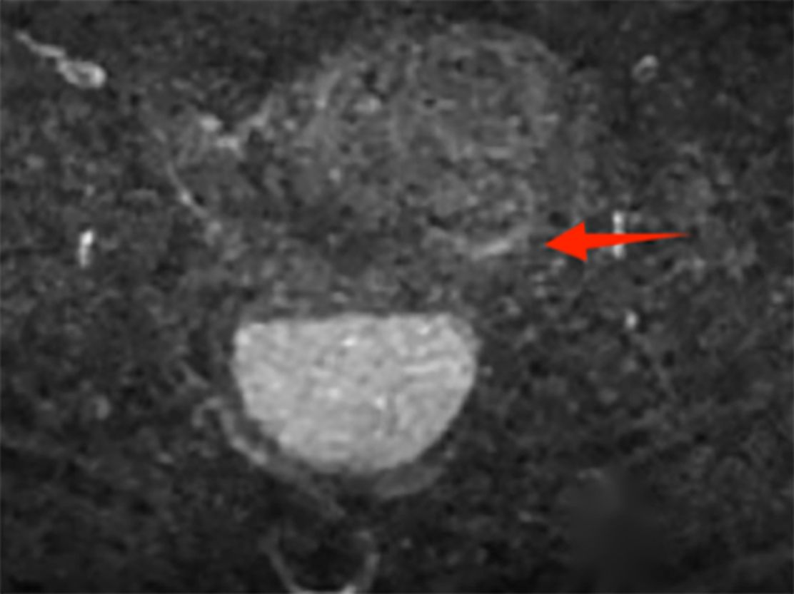 MRI scan showing a cross-sectional view of the sciatic nerve. The nerve appears as a circular structure near the center. A red arrow points to an area of interest nearby, possibly highlighting a specific detail for clinical assessment.