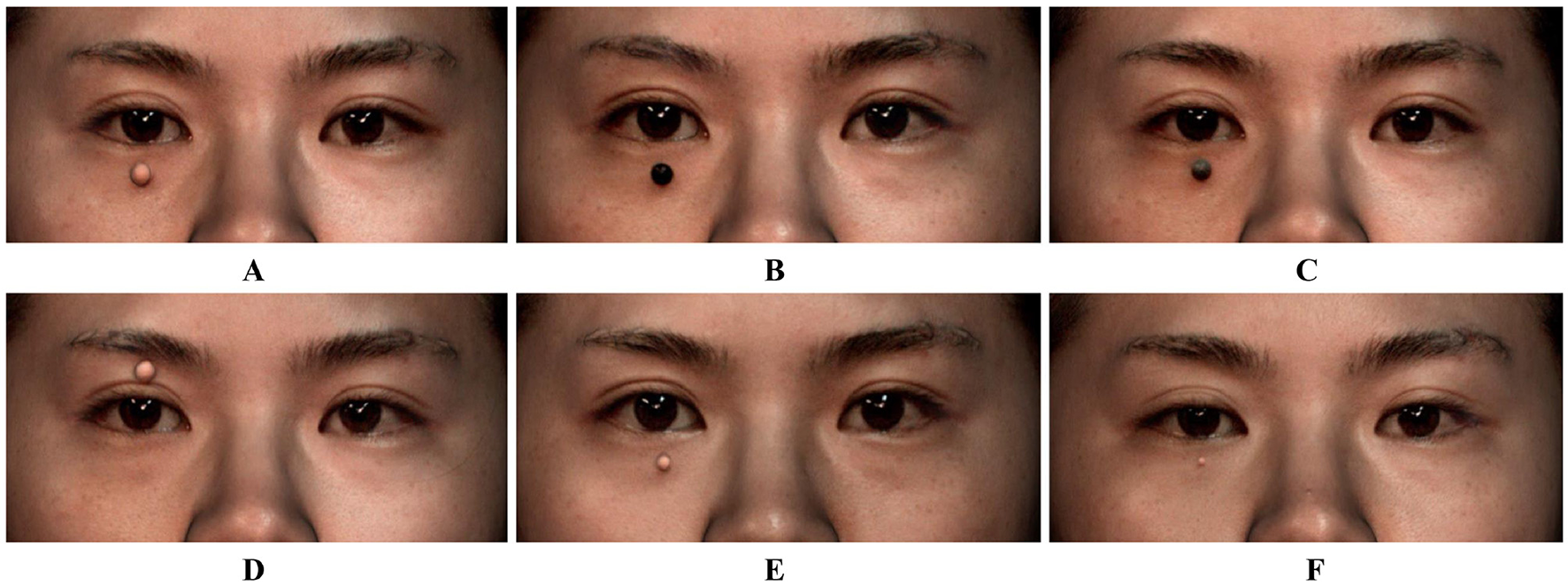 Six close-up images of the periorbital region of volunteers show models of different colors and sizes affixed to different locations. Image A shows a 6 mm diameter flesh-colored model affixed to the lower eyelid. Image B shows a 6 mm diameter black model affixed to the lower eyelid. Image C shows a 6 mm diameter gray model affixed to the lower eyelid. Image D shows a 6 mm flesh-colored model attached to the upper eyelid. Image E shows a 4 mm flesh-colored model attached to the lower eyelid. Image F shows a 2 mm flesh-colored model attached to the lower eyelid.