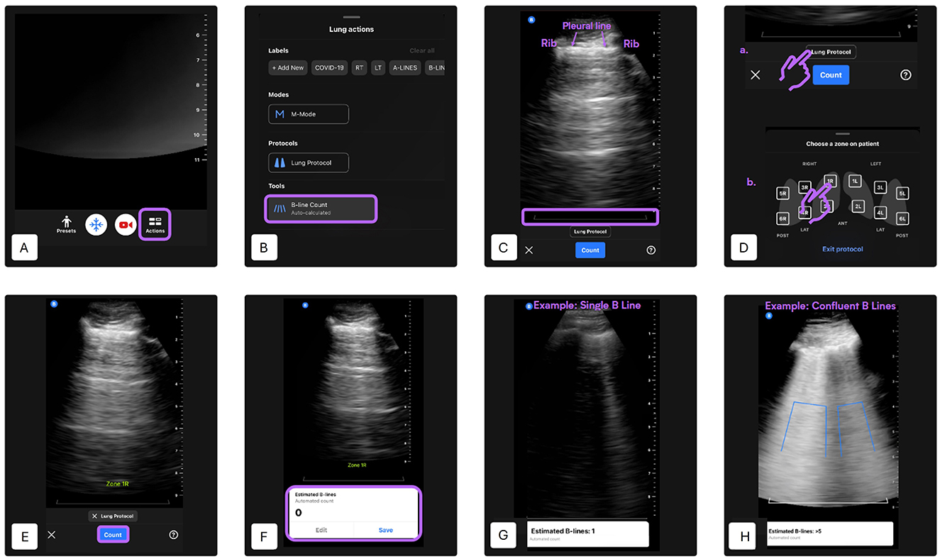 Ultrasound interface steps for B-line detection: A) Initial ultrasound display with “Actions.” B) “Lung actions” menu showing options and “B-line Count” tool. C) Ultrasound image marked with pleural and rib lines, “Lung Protocol” highlighted. D) Directions for selecting lung zones. E) Ultrasound view with “Zone 3R” label. F) “Estimated B-lines” display showing zero. G) Example of a single B-line labeled. H) Example of confluent B-lines with count.