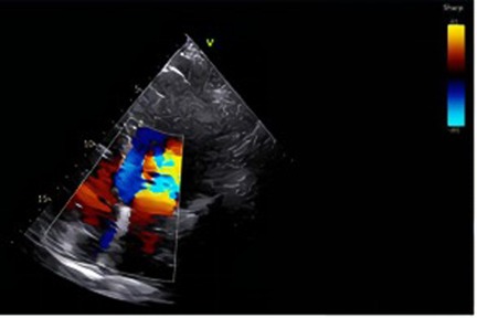 Ultrasound image showing a color Doppler representation of blood flow within a heart chamber. The flow is indicated by varying shades of blue and red, with a color scale on the right indicating flow direction and velocity. The top of the image shows a triangular sector of grayscale echocardiographic view.