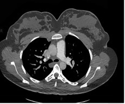 CT scan of a chest cross-section showing the lungs, heart, and surrounding structures. The image displays varying tissue densities with dark areas indicating air-filled spaces and lighter shades representing denser tissues like bone and muscle.
