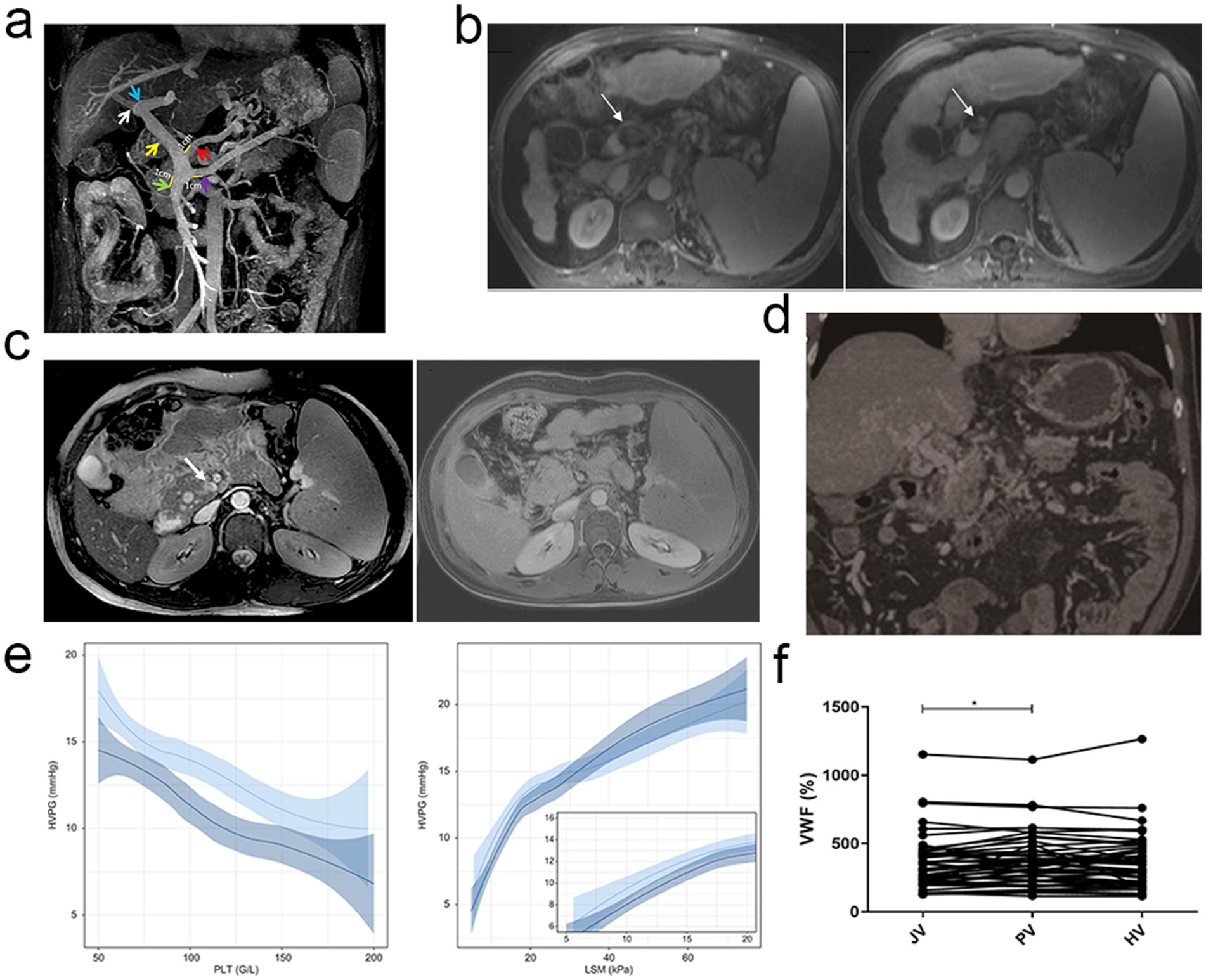 MRI images (a-d) show various views of abdominal structures with highlighted regions and arrows indicating specific areas of interest. Graphs (e) display data with shaded confidence intervals, illustrating relationships between variables like PLT and HVPG, and LSM and HVPG. Graph (f) shows VWF percentages across different conditions JV, PV, and HV, with connecting lines illustrating trends.