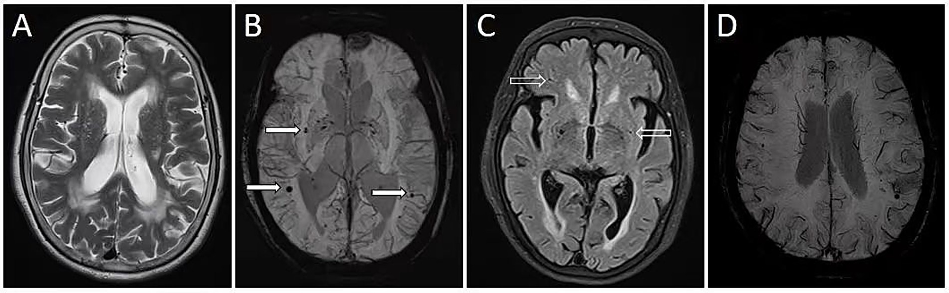 Four brain MRI scans labeled A to D. Image A shows white matter hyperintensities. Image B shows cerebral microbleeds (indicated by arrowheads). Image C shows lacunar infarctions (indicated by an arrowhead). Image D shows deep medullary veins.
