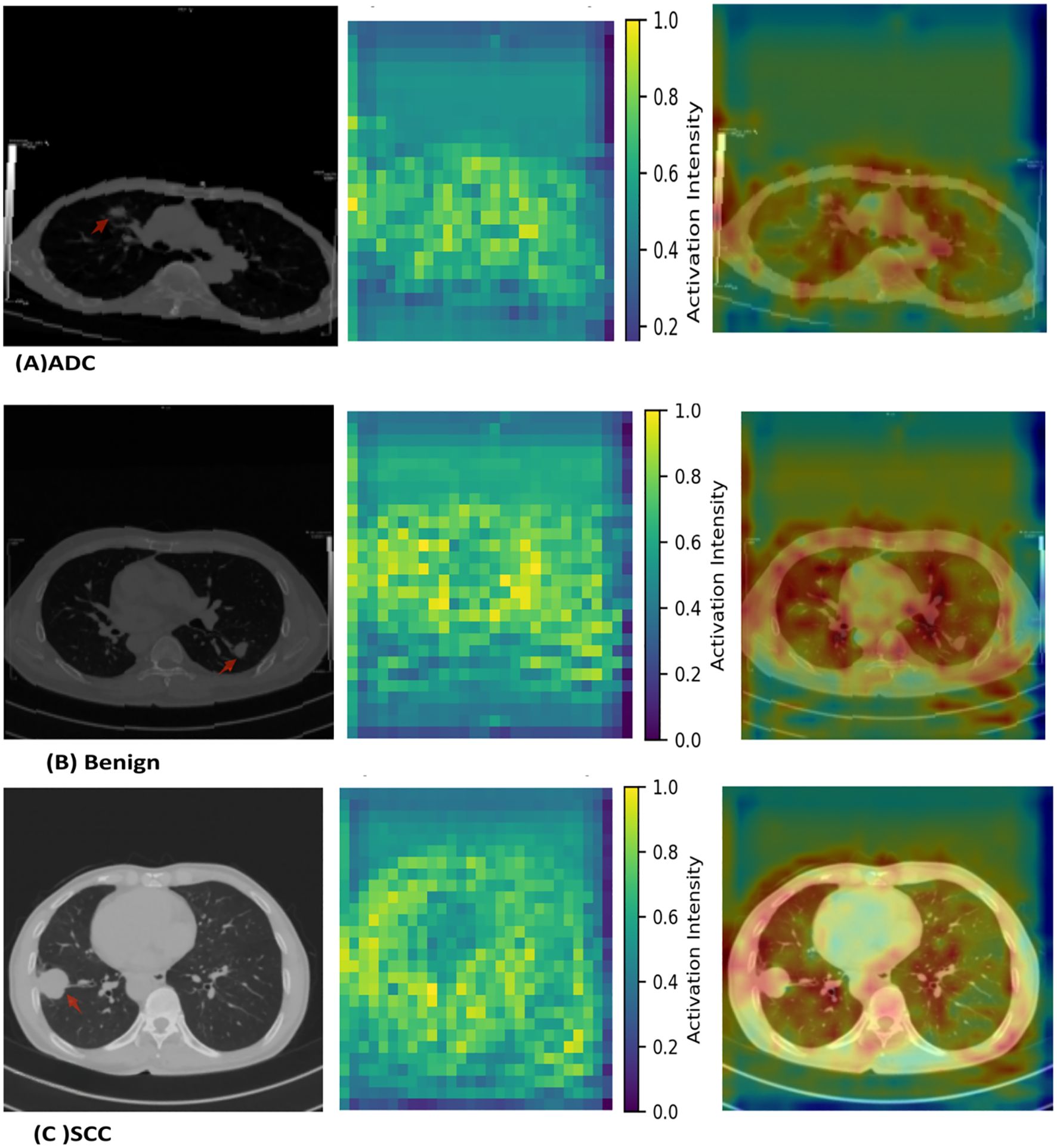 Three sets of lung images are shown, each with a CT scan, a heatmap, and an activation overlay. (A) ADC shows a CT with an arrow pointing to a mass, a heatmap with varying intensities, and an activation overlay. (B) Benign displays similar content with another mass indicated by an arrow. (C) SCC features a CT with a highlighted area, accompanied by its respective heatmap and overlay. Each set includes a color bar indicating activation intensities from 0.0 to 1.0.