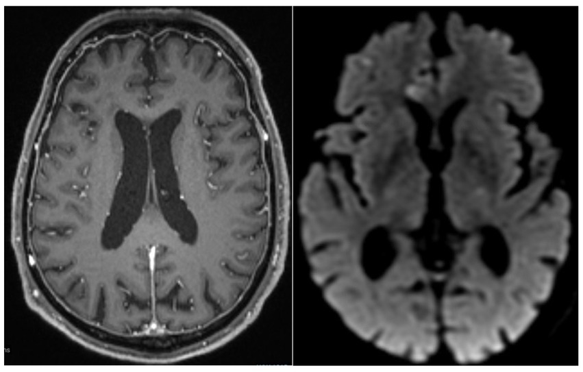 Two MRI brain scans side by side. The left image shows a cross-sectional view highlighting brain structures with distinct white matter. The right image displays a different MRI view with more diffuse, grayscale features, showing less defined areas.