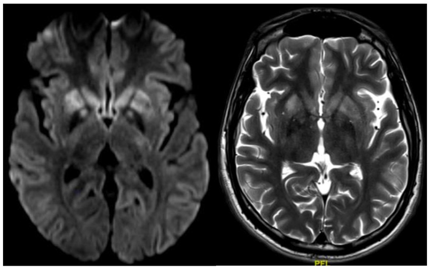Two MRI brain scans side by side, showing different imaging techniques. The left scan presents a blurred, darker view, while the right scan displays clear, detailed brain structures with higher contrast between tissues.