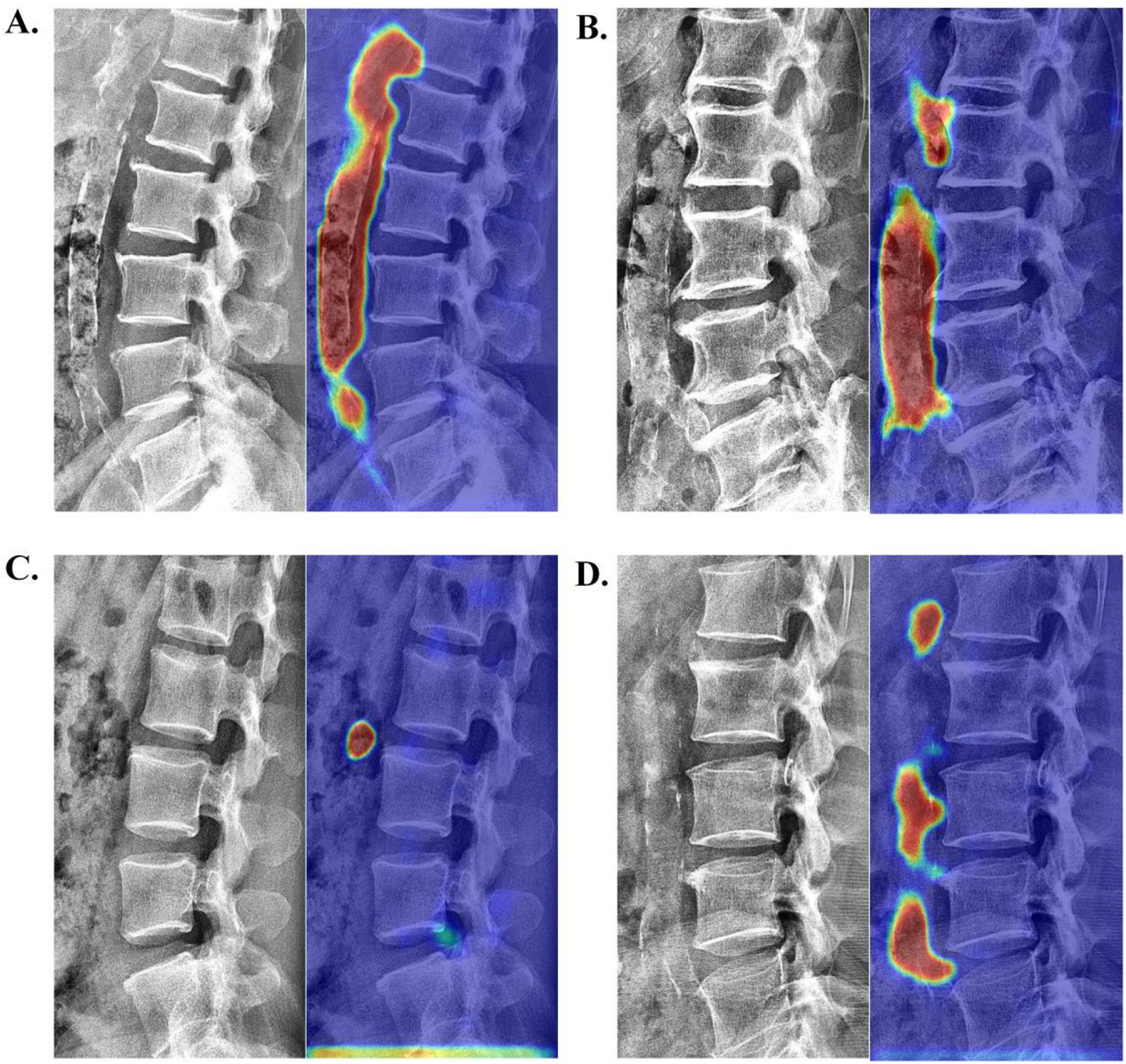 Figure visualizes neural network activation maps from an automated Abdominal Aortic Calcification (AAC) scoring system for four representative cases: (A) chronic kidney disease (scores: 23/22), (B) hypertension (19/17), (C) hyperlipidemia (1/1), and (D) coronary artery disease (10/11). Each panel shows the original image alongside a color-enhanced overlay where the model focused for its prediction. The highlighted areas correlate with calcification severity, demonstrating the model's accuracy across diverse cardiovascular risk profiles.